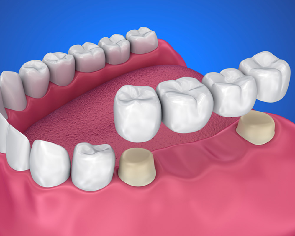 dental bridges near you