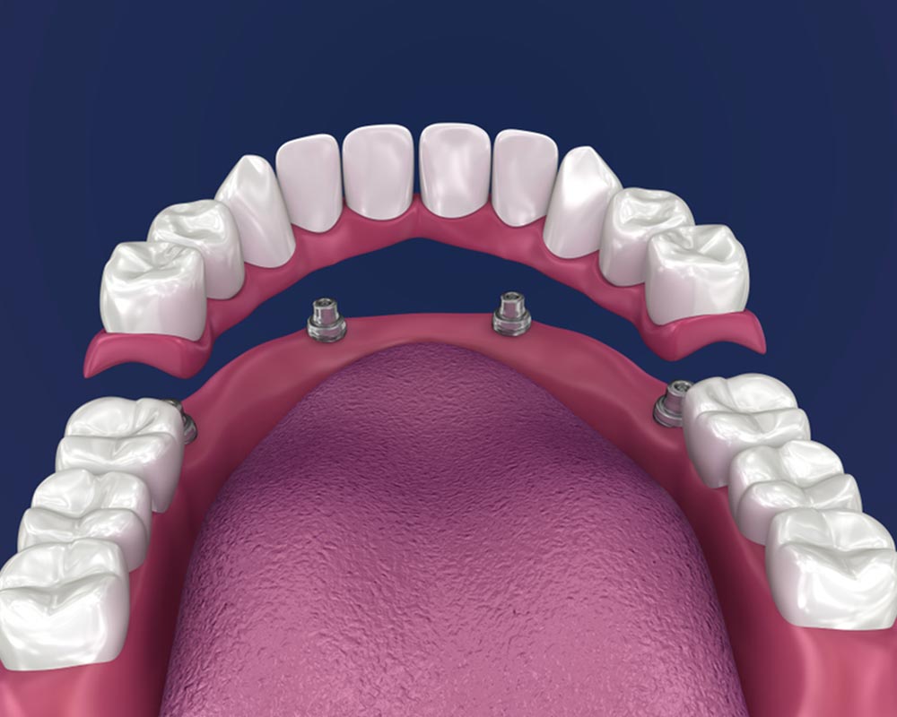 dental implants in sw calgary
