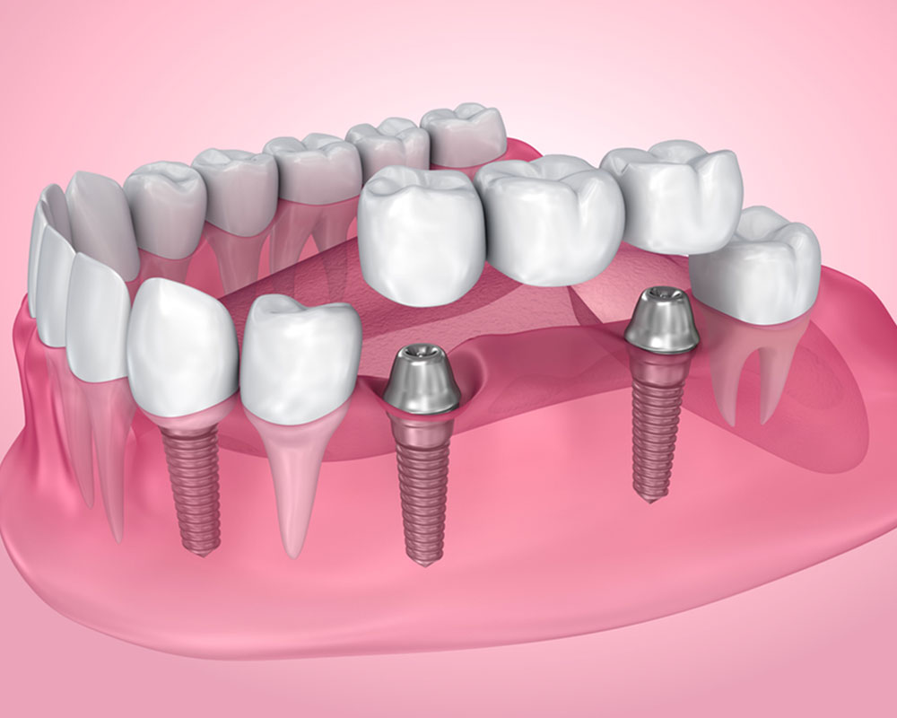 dental implants near you