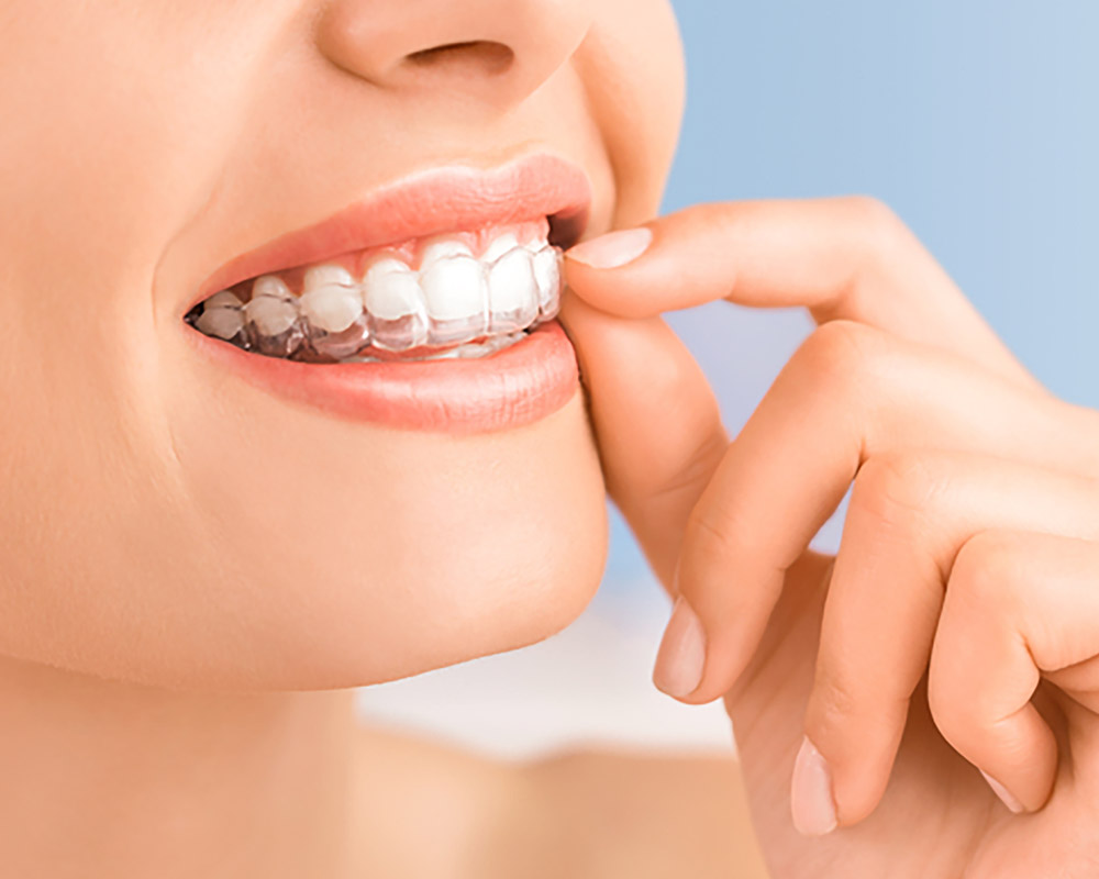 invisalign in sw calgary