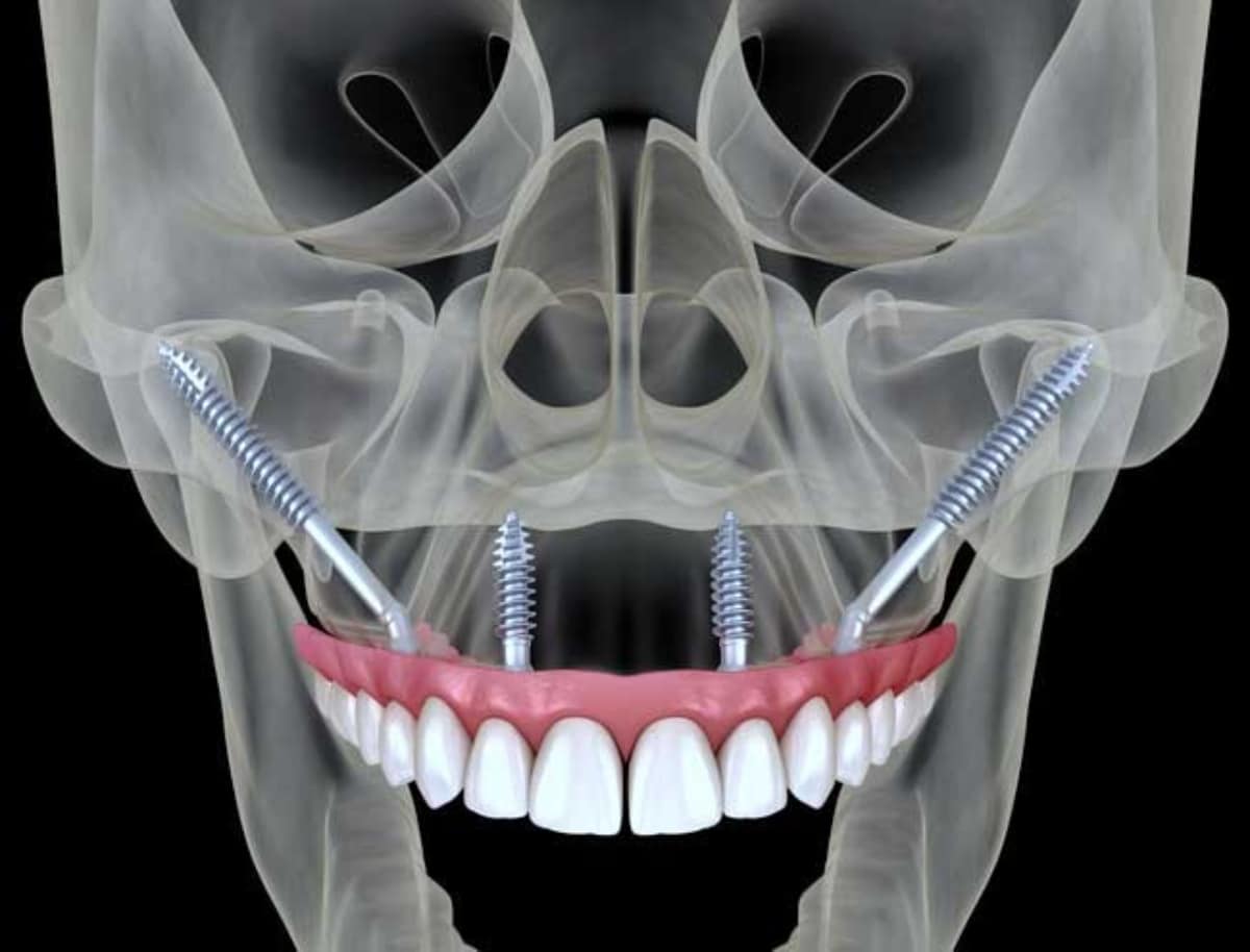 Are Dental Implants An Option If I've Suffered Jaw Bone Loss?